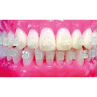 Purity brekety MBT s háčky .022 20 ks