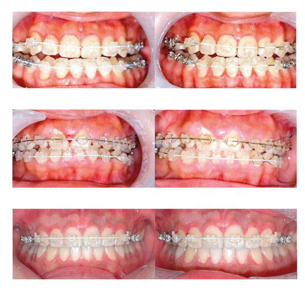 Euroform Cosmetic Tooth Coloured nerez .012 horní