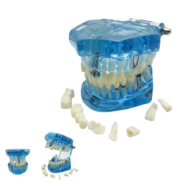 Model čelisti s implantáty modrý transparentní
