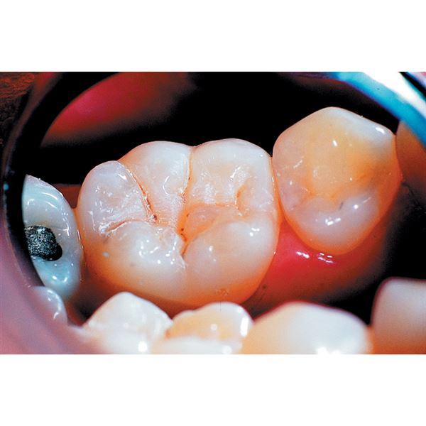 UltraSeal XT Plus op.bílá 20 x 1,2 ml