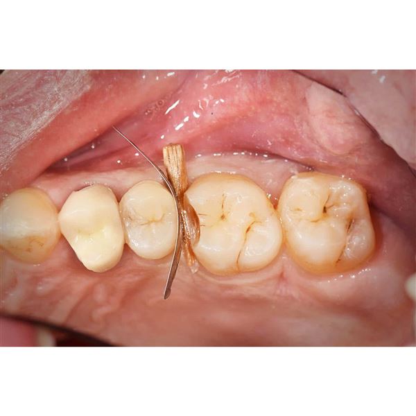 PolydentiaPRO Interproximal matrice 0,05mm, 100Pcs.