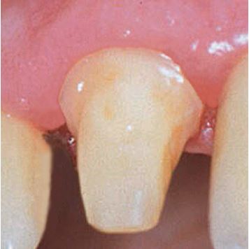 Comprecap Anatomic č.5 (L) 60 ks