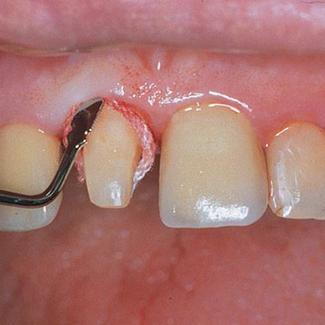 Comprecap Anatomic č.5 (L) 60 ks