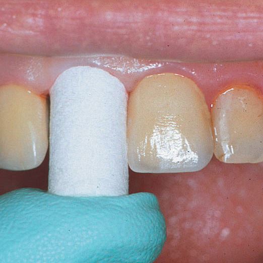 Comprecap Anatomic č.5 (L) 60 ks