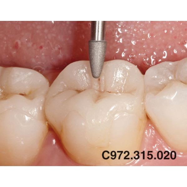 Occlusal Shaper velmi jemný žlutý ED C972.315.020