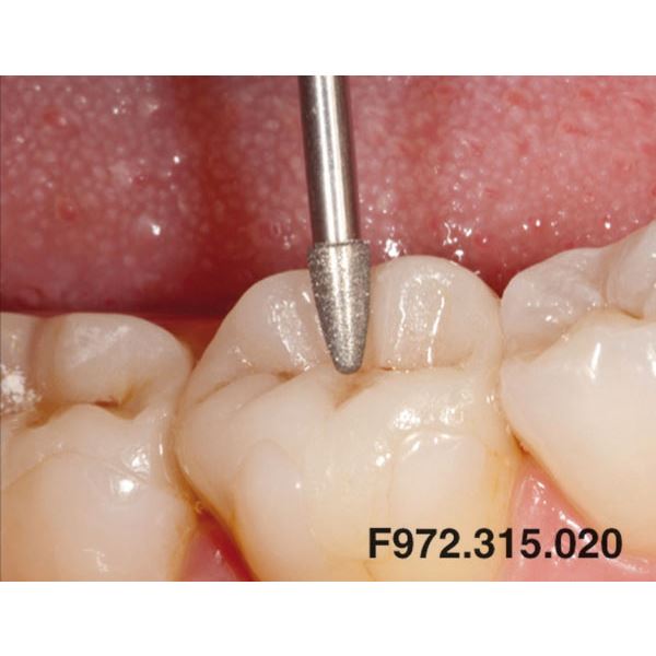 Occlusal Shaper jemný červený ED F972.315.020