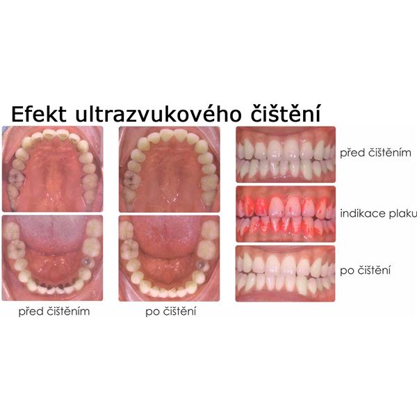 Woodpecker PT-A Dental Scaler and Air Polisher