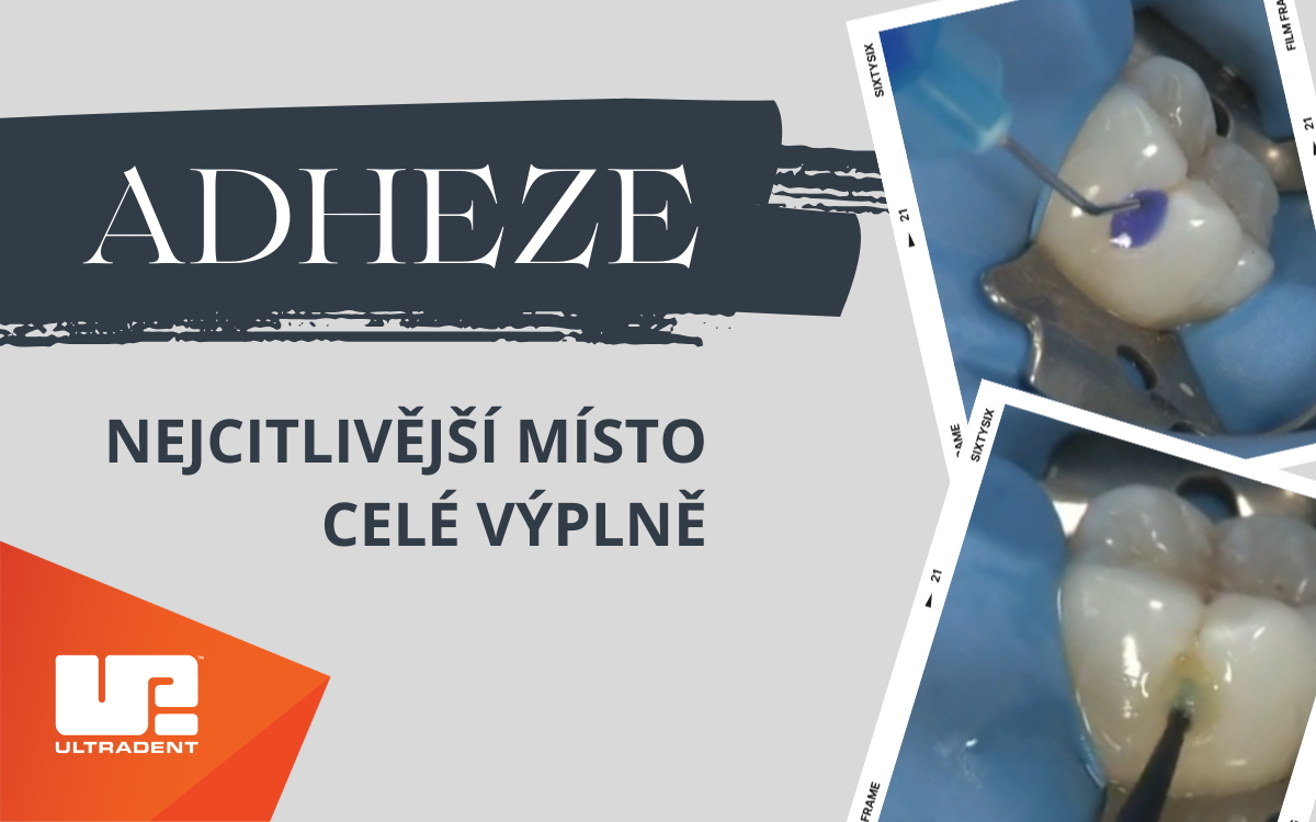 Perfektní bonding, na který se můžete spolehnout