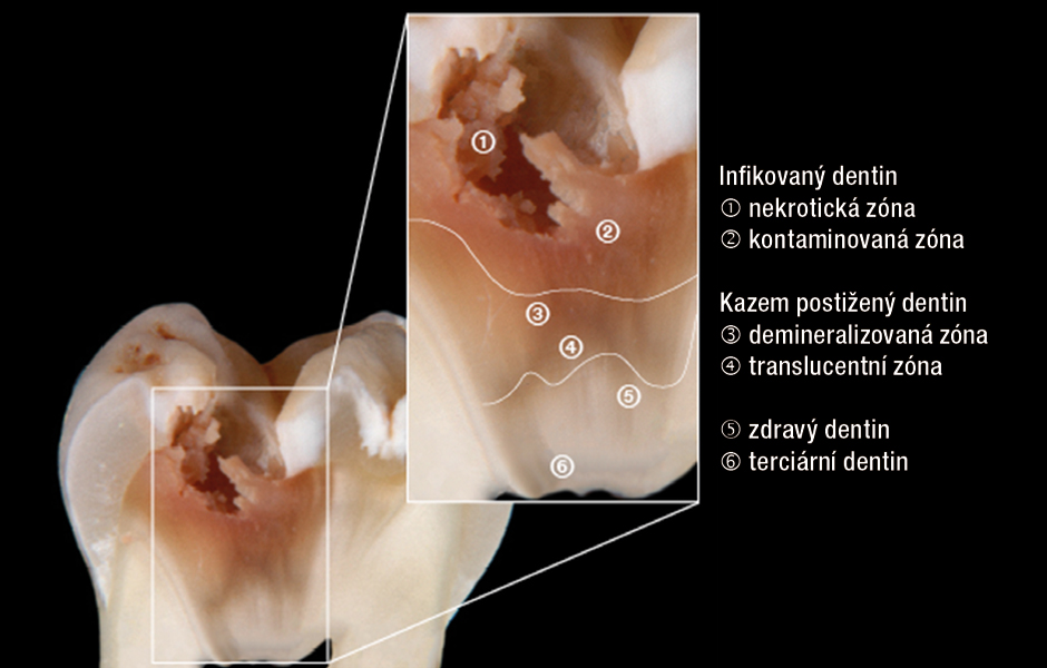 Minimálně invazivní stomatologie: Udělejte více tím, že uděláte méně