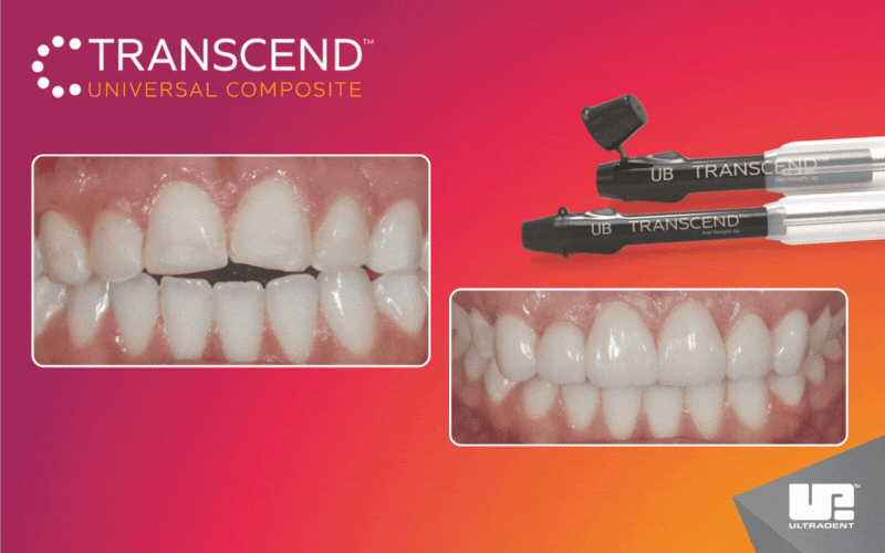 Klinický protokol pro kompozitní fazety bez preparace